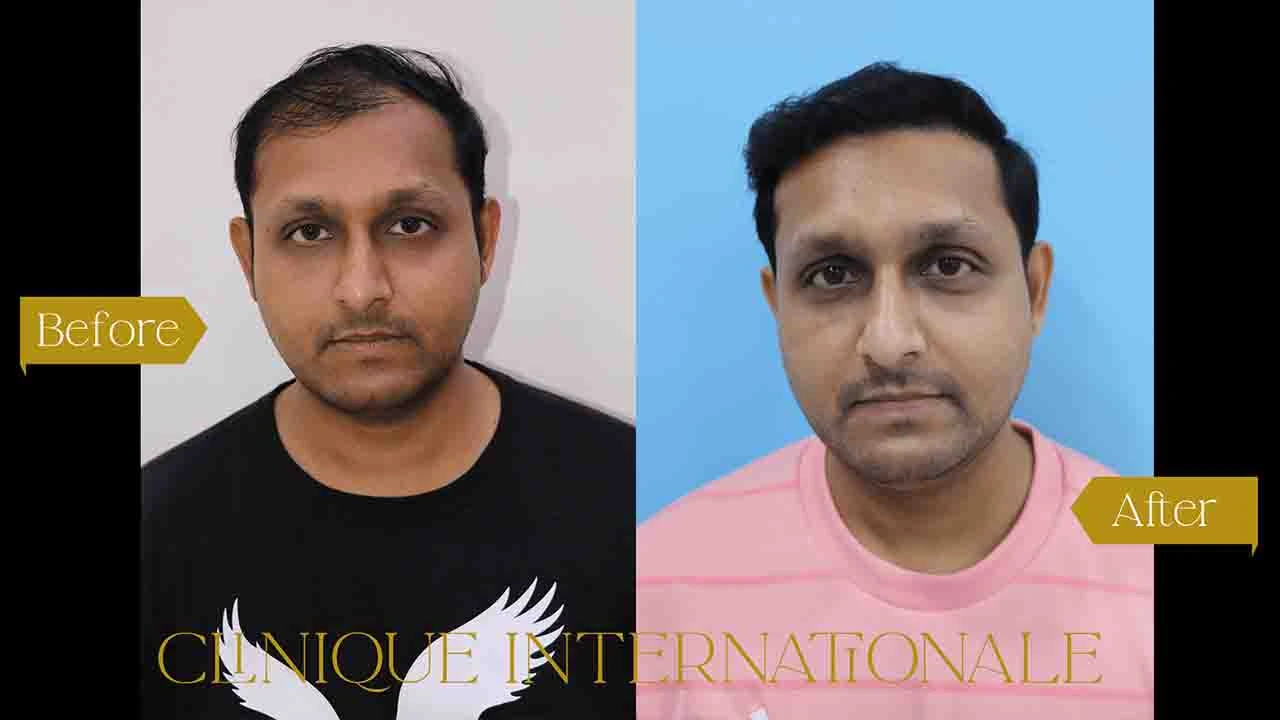 Best Hair Transplant in Bangalore